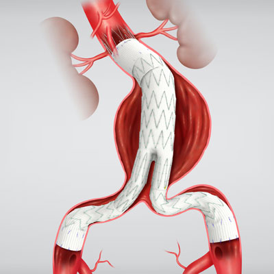 Prothèse endo aortique